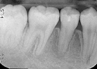 autotransplantation of teeth