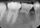 autotransplantation of teeth