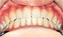 Do the upper (front and back) teeth cover the upper teeth when you look up and view them from below?