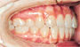 Are the upper and lower teeth fitting close together?
