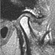 TMJ disc displaced significantly