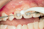 矯正治療中の虫歯ケア：クリーニング