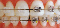 透明な歯科矯正装置